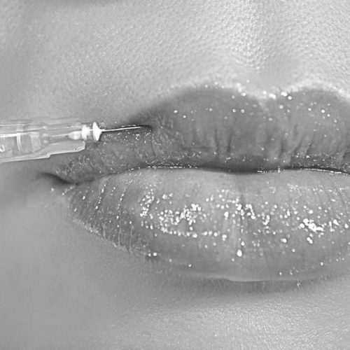 Lip Filler – Dos and Donts