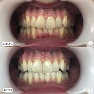 Teeth Whitening