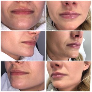 Lip Filler