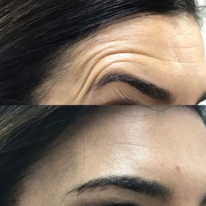 Anti-Wrinkle By Dr. Mona